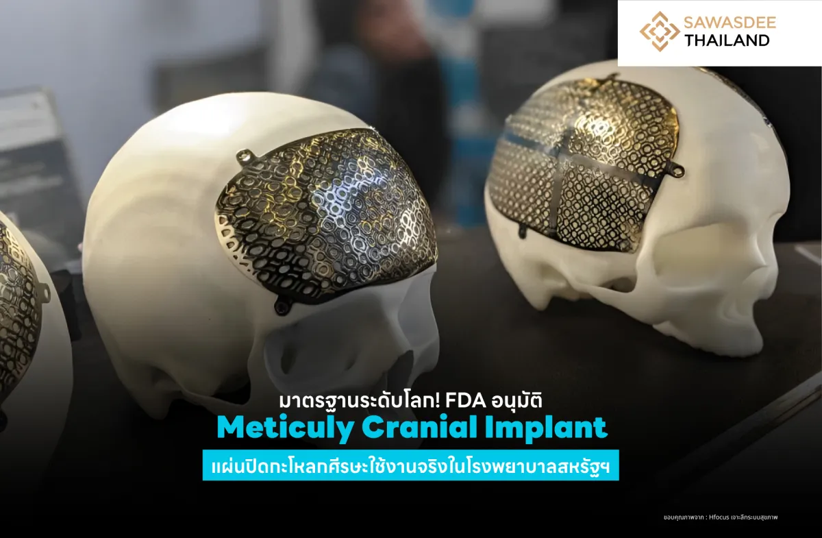 มาตรฐานระดับโลก ! FDA อนุมัติ Meticuly Cranial Implant แผ่นปิดกะโหลกศีรษะ ใช้งานจริงในโรงพยาบาลสหรัฐฯ